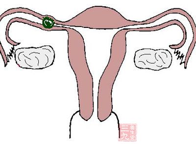月经有黑色血块，可能的原因有宫外孕
