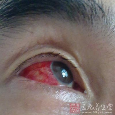 紅眼病”預防和其他傳染病一樣,必須抓住消滅傳染源、切斷傳播途徑