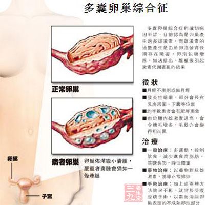 女汉子防着<em>多囊卵巢综合征</em> 有男性化表现 - 三
