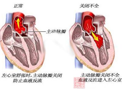 左心室容量过大是引起二尖瓣关闭不全，患者心悸气短的另一重要原因。病变的后期可有肺水肿、咯血和右心衰竭