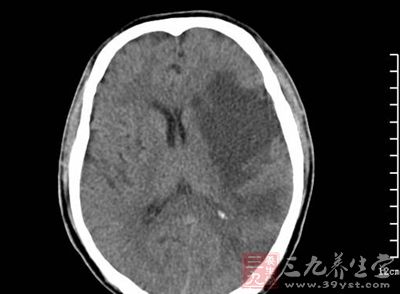 脑梗死的临床常见类型有脑血栓形成、腔隙性梗死和脑栓塞等