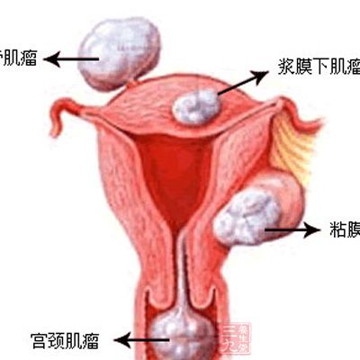 子宫肌腺症指的是子宫内膜侵入了子宫肌层