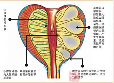 前列腺,让男人很无奈