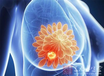 乳腺癌的症状_乳腺癌的治疗方法及化疗方案