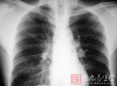 尘肺病是职业病高发病种 可申请职业病诊断