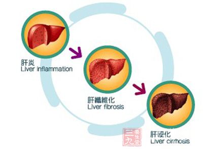 Nature Medicine刊文揭示乙肝难愈之谜 - 三九养生堂