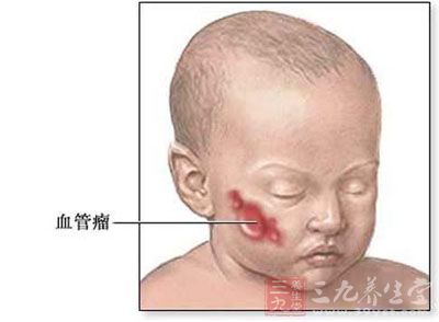 宝宝脸上长一物小心是血管瘤