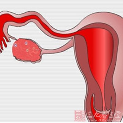 慢性盆腔炎如何根治 怎样治疗预防慢性盆腔炎