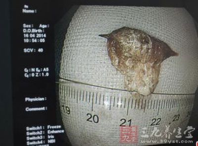 吃颗大枣,一不小心枣核卡到喉咙里了 吃颗大枣,一不小心枣核卡到喉咙里了