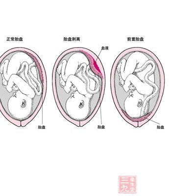 胎盘是胚胎和母体组织的结合体,它是由羊膜,叶状绒毛膜和底蜕膜构成的