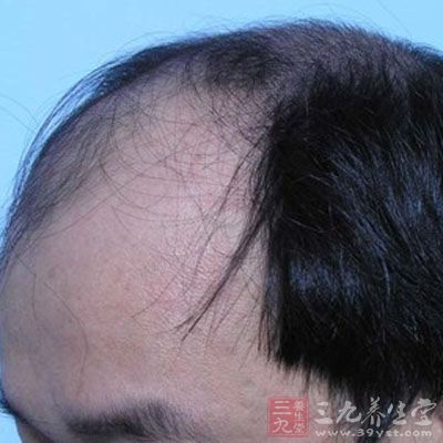 年龄的增长,男性头发上毛囊的数量日益减少,<em>头发越来越稀</em>