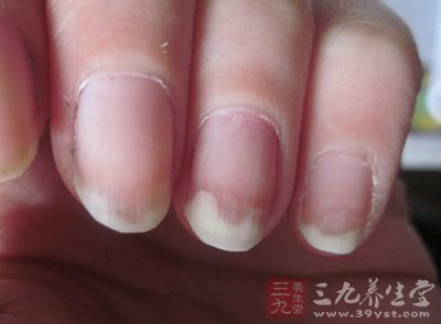 治疗灰指甲的最佳方法 如何治疗灰指甲