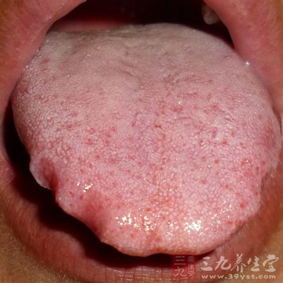 舌苔发白,病情具有一般的感冒症状,多为风寒性感冒,这是需要选用解