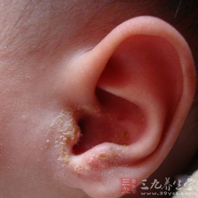 在炎热的天气由于耳朵进水,细菌能够快速繁殖,会引起急型化脓性中耳炎