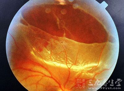 高度近视六旬网脱患者双眼手术7次