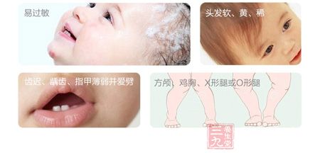 方颅、鸡胸、X型腿或O型腿