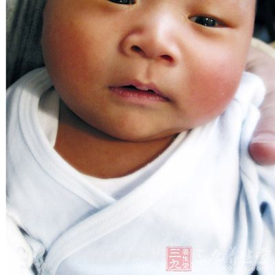 新生儿黄疸 中医治疗新生儿黄疸