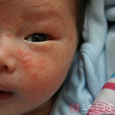 新生儿湿疹 中医治疗新生儿湿疹 - 南张乡卫生院 - 南张乡中心卫生院 新生儿湿疹 中医治疗新生儿湿疹 - 南张乡卫生院 - 南张乡中心卫生院