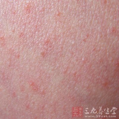 新生儿湿疹 中医治疗新生儿湿疹 - 南张乡卫生院 - 南张乡中心卫生院 新生儿湿疹 中医治疗新生儿湿疹 - 南张乡卫生院 - 南张乡中心卫生院