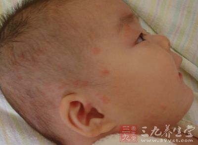 新生儿湿疹 中医治疗新生儿湿疹 - 南张乡卫生院 - 南张乡中心卫生院 新生儿湿疹 中医治疗新生儿湿疹 - 南张乡卫生院 - 南张乡中心卫生院