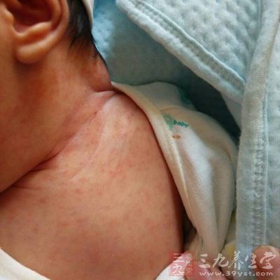 新生儿湿疹 中医治疗新生儿湿疹 - 南张乡卫生院 - 南张乡中心卫生院 新生儿湿疹 中医治疗新生儿湿疹 - 南张乡卫生院 - 南张乡中心卫生院