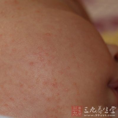 新生儿湿疹 中医治疗新生儿湿疹 - 南张乡卫生院 - 南张乡中心卫生院 新生儿湿疹 中医治疗新生儿湿疹 - 南张乡卫生院 - 南张乡中心卫生院