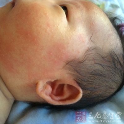 新生儿湿疹 中医治疗新生儿湿疹 - 南张乡卫生院 - 南张乡中心卫生院 新生儿湿疹 中医治疗新生儿湿疹 - 南张乡卫生院 - 南张乡中心卫生院