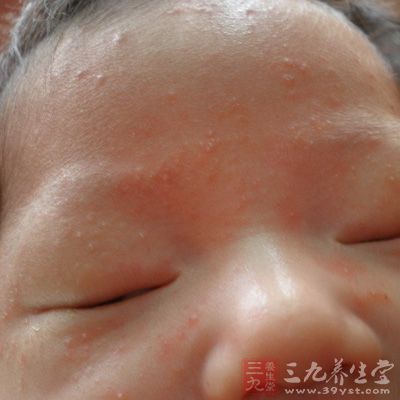 新生儿湿疹 中医治疗新生儿湿疹 - 南张乡卫生院 - 南张乡中心卫生院 新生儿湿疹 中医治疗新生儿湿疹 - 南张乡卫生院 - 南张乡中心卫生院