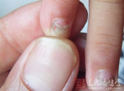 指甲呈半圆形,则是肾功能不佳;   指甲呈筒形,表明有癌症的预兆