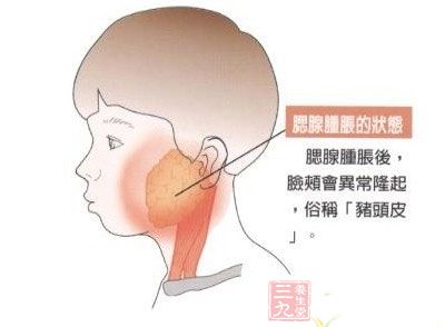 腮腺炎后患潜伏20年 竟致<em>女子无法生育</em> - 三九
