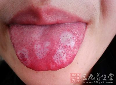 舌头白斑的情况可能是舌头发炎而引起的