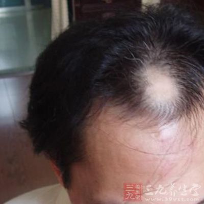 脱发是秃顶的前兆，所以要尽早发现自己的头发状况
