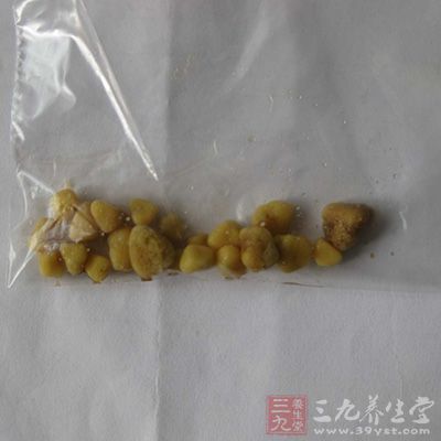 肾结石吃什么 这些食疗方法治愈肾结石