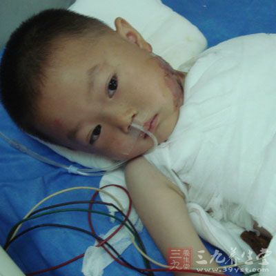 孩子涂蚊子包止痒竟着火