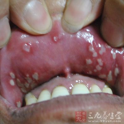 口腔溃疡也是身体重大疾病的预警之一