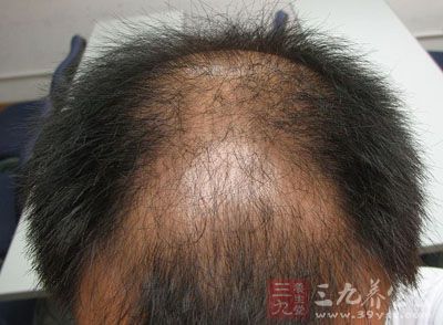 男人这里<em>少</em>毛竟因身体<em>有病</em> - 三九养生堂