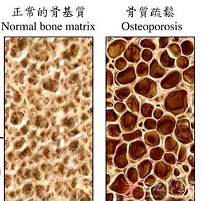 骨质疏松，是骨组织像蜂窝煤一样，密度低了，强度弱了