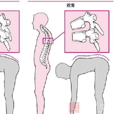 身长缩短、驼背