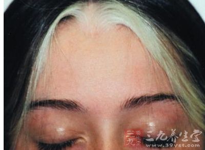 额前<em>长白发</em>竟是因为患了病