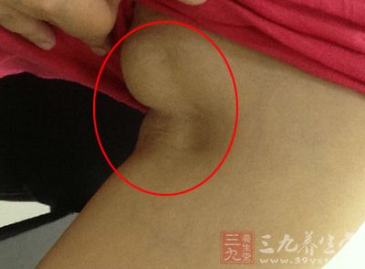 女人腋下长出它出大事了