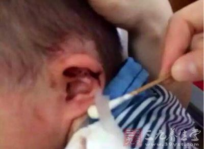 4岁男童被幼师拽倒受伤 耳朵缝了10多针