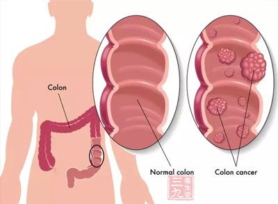 80%肠息肉易致癌 肠镜检查防微杜渐