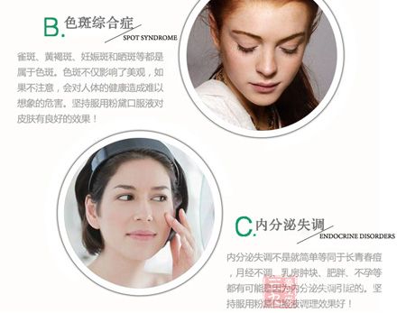 雀斑、黄褐斑、妊娠斑和晒斑等都是属于色斑