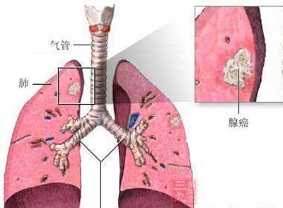 我国肺癌的构成比正在变化 不吸烟腺癌上升