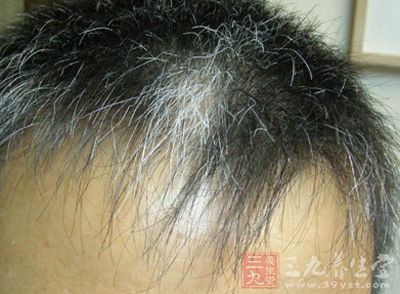 额前长白发竟是因为患了病