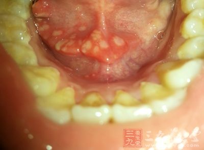 中医认为舌和心脏的关系为密切,所以溃疡长在舌头上