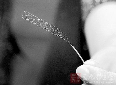 缺血性脑卒中革命性治疗新技术 支架取栓