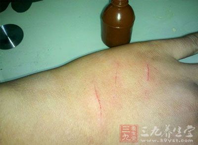 24岁小伙持续发烧3个月 原来是得了"猫抓病"