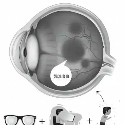 大学生玩网游8小时 左眼突然一片模糊险失明