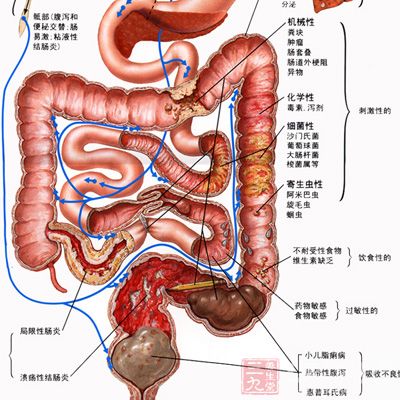判断是否患有肛肠癌